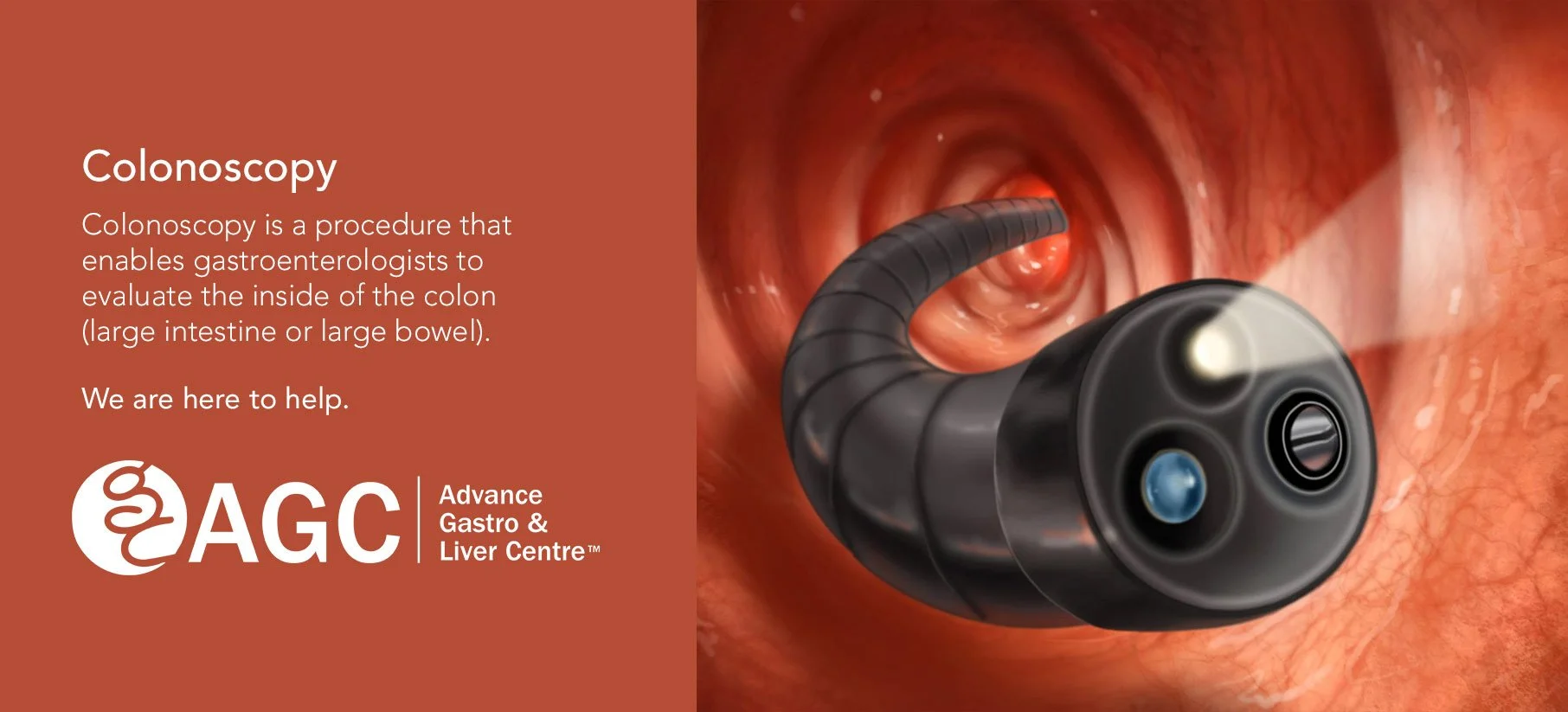 Colonoscopy