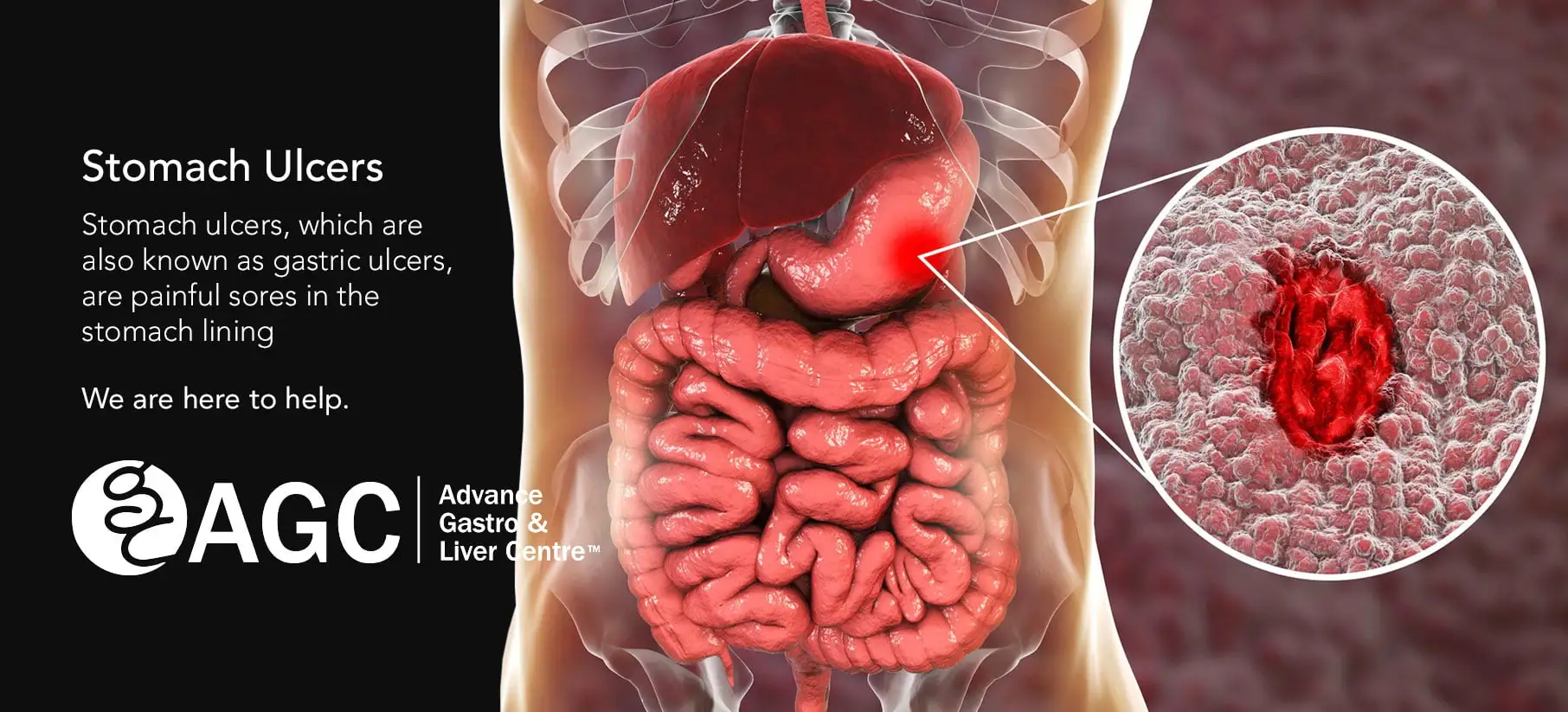Stomach-ulcers-treatment-in-Indore
