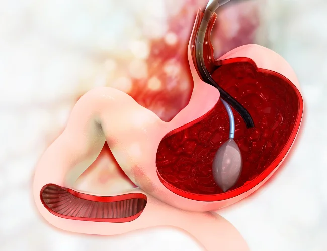 Bariatric Gastric Balloon Treatment | Shivaay advance gastro and liver centre