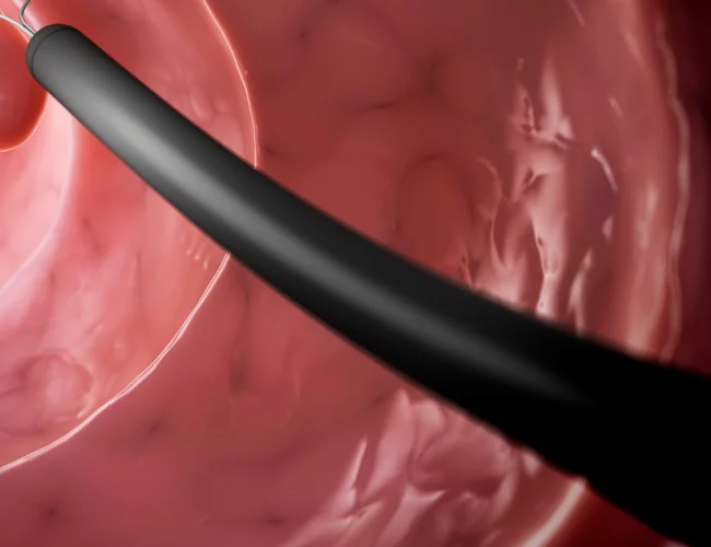 PEG | Shivaay advance gastro and liver centre