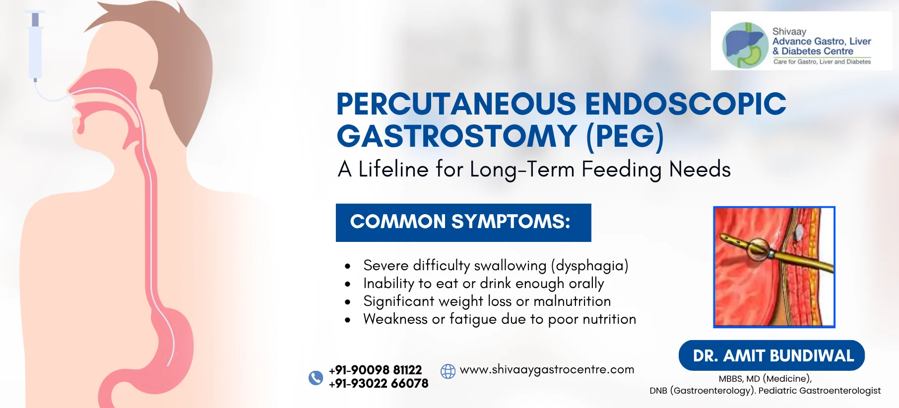 PEG | Shivaay advance gastro and liver centre