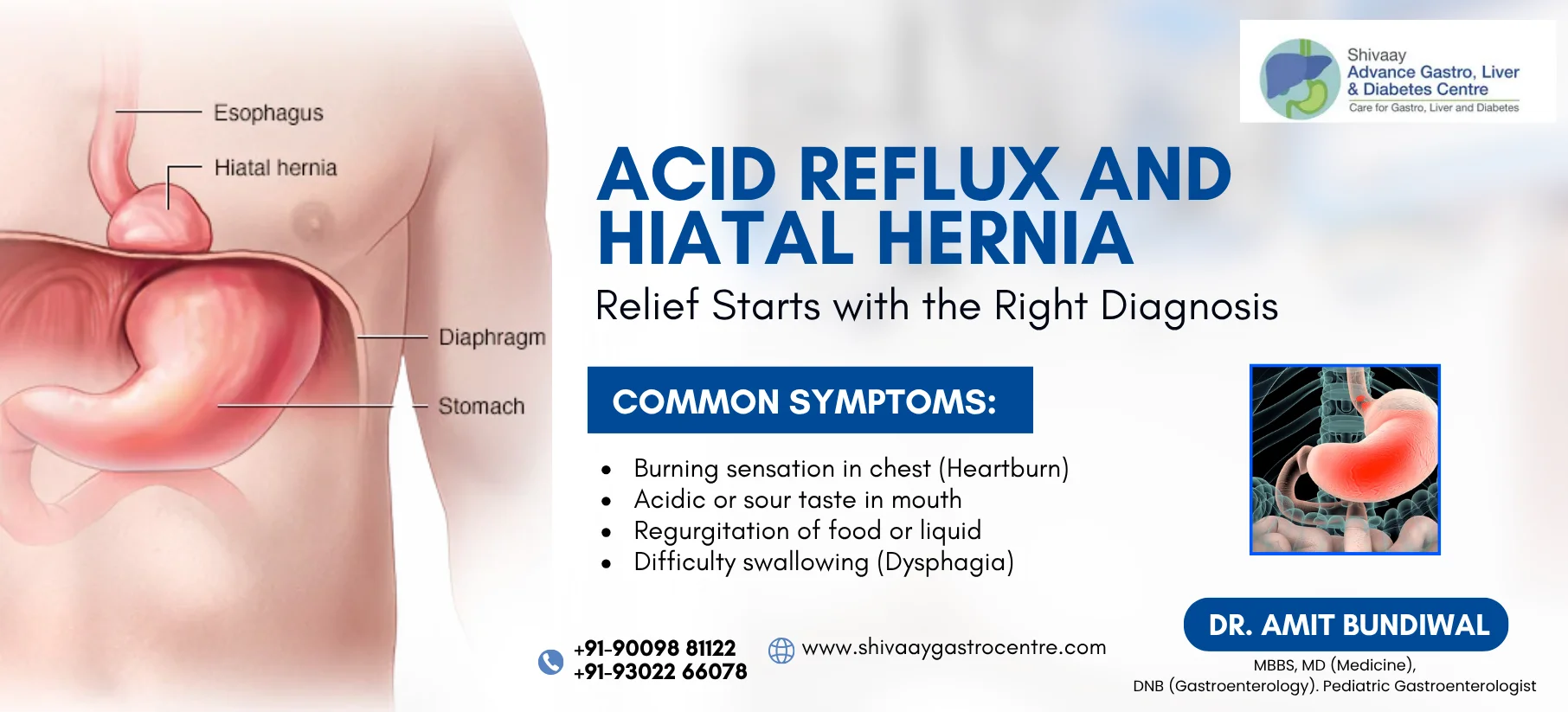 Acid reflux | Treatment at shivaay advance gastro centre