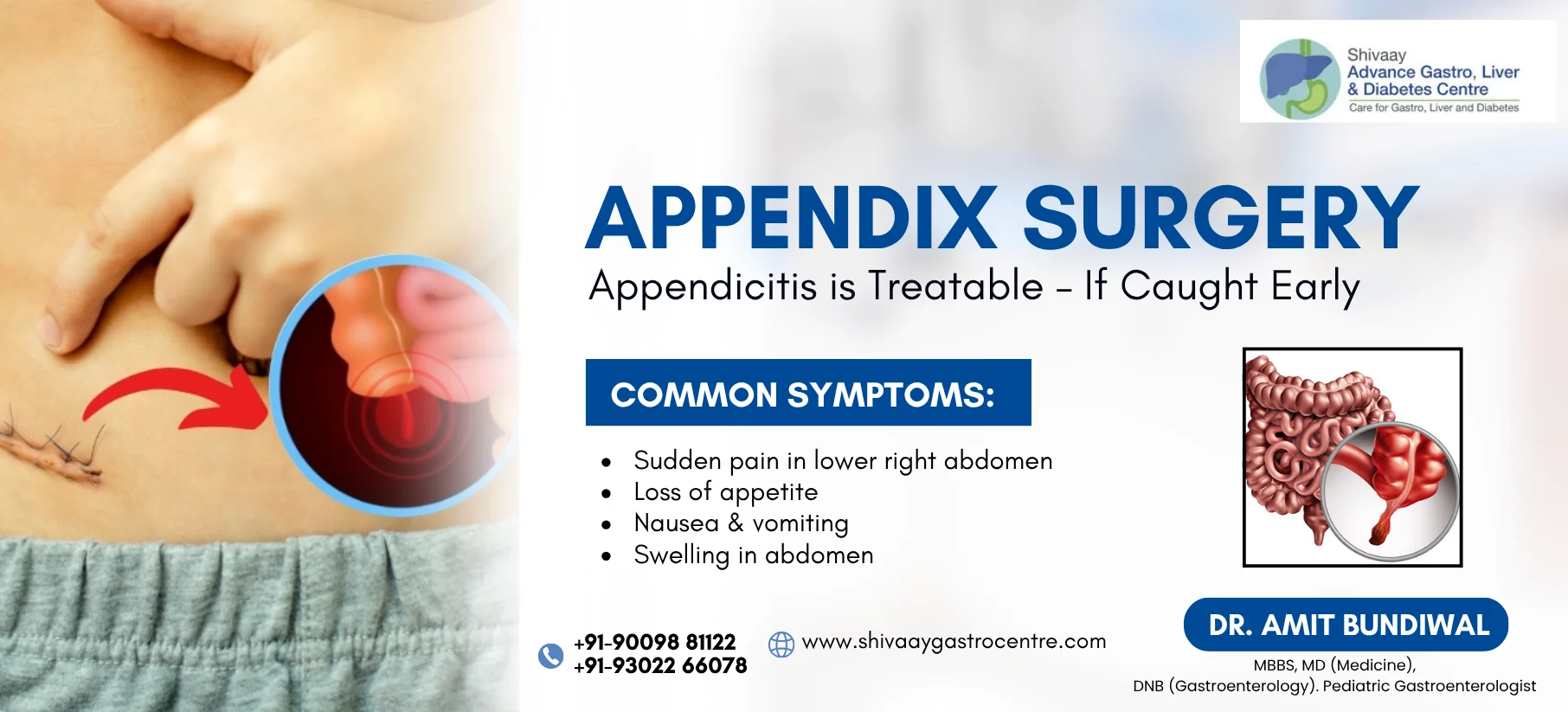 appendix treatment at shivaay advance gastro centre