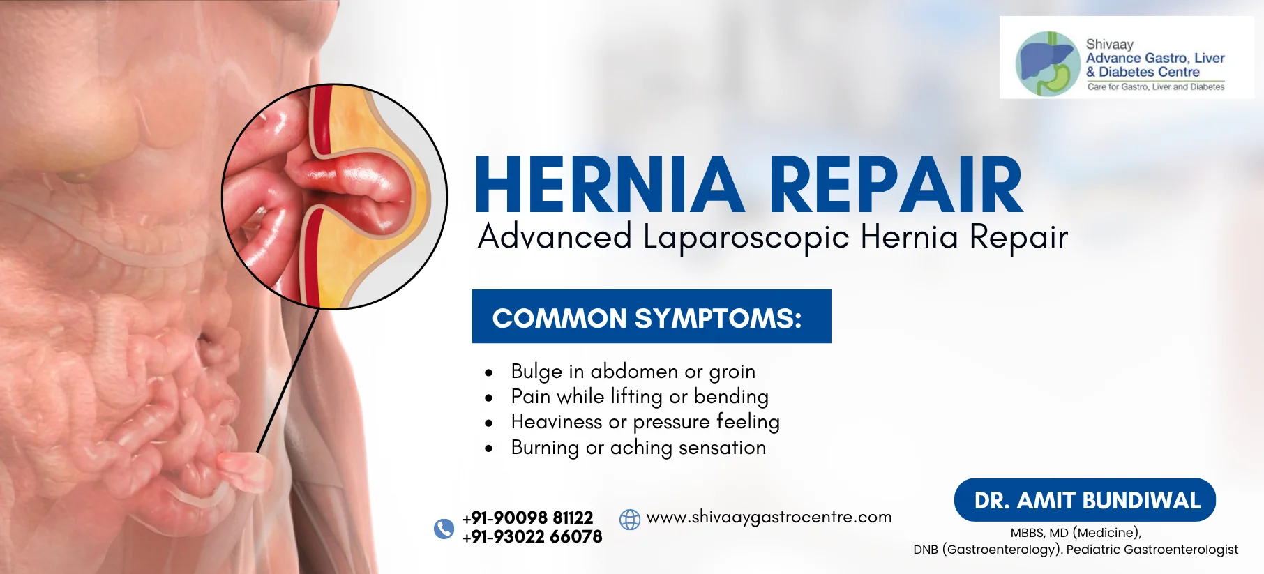 hernia treatment at shivaay advance gastro centre